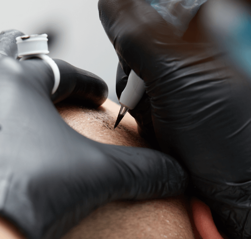 Tricopigmentacion Capilar en Madrid