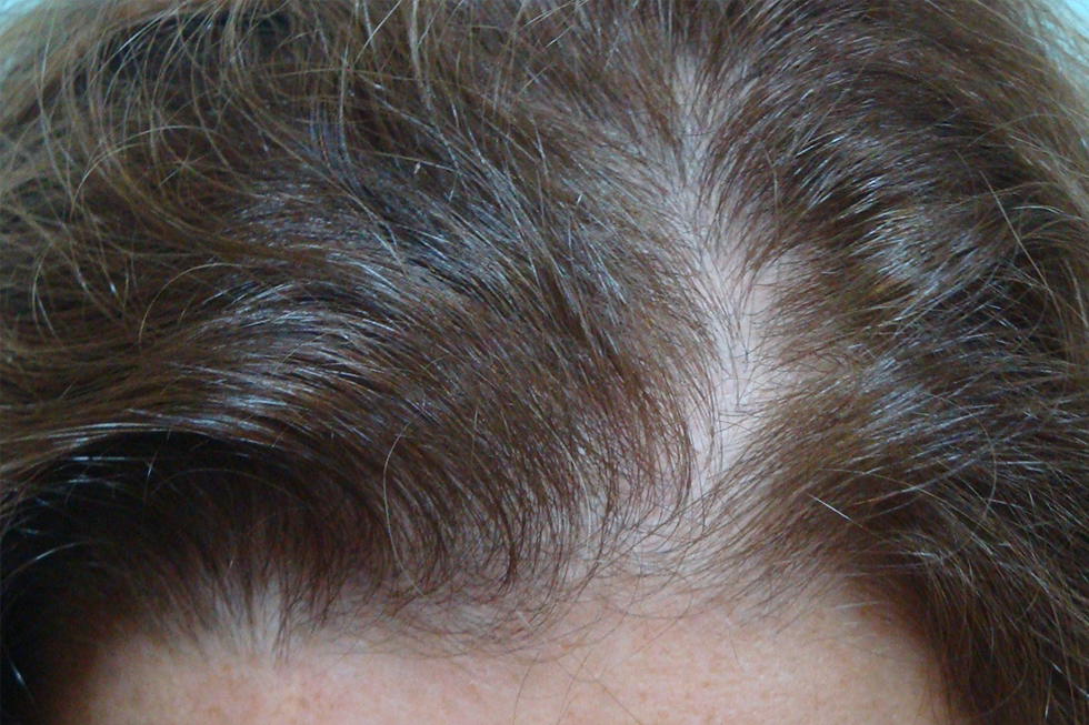 Alopecia