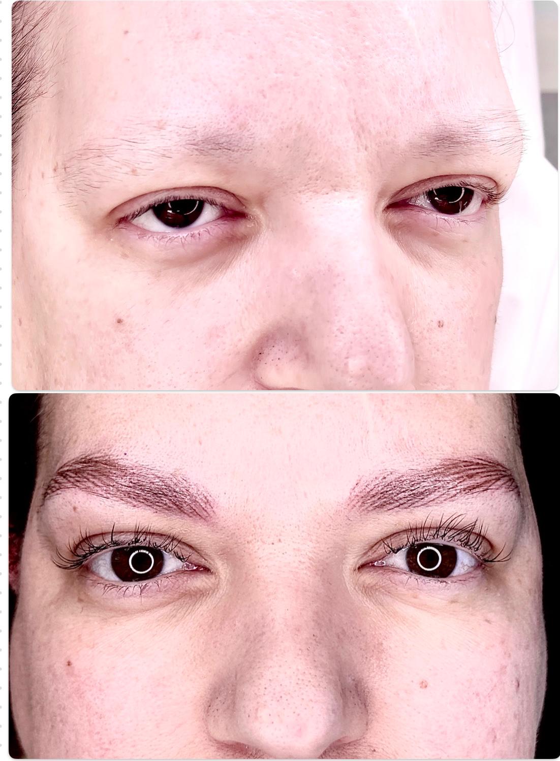Alopecia en las cejas