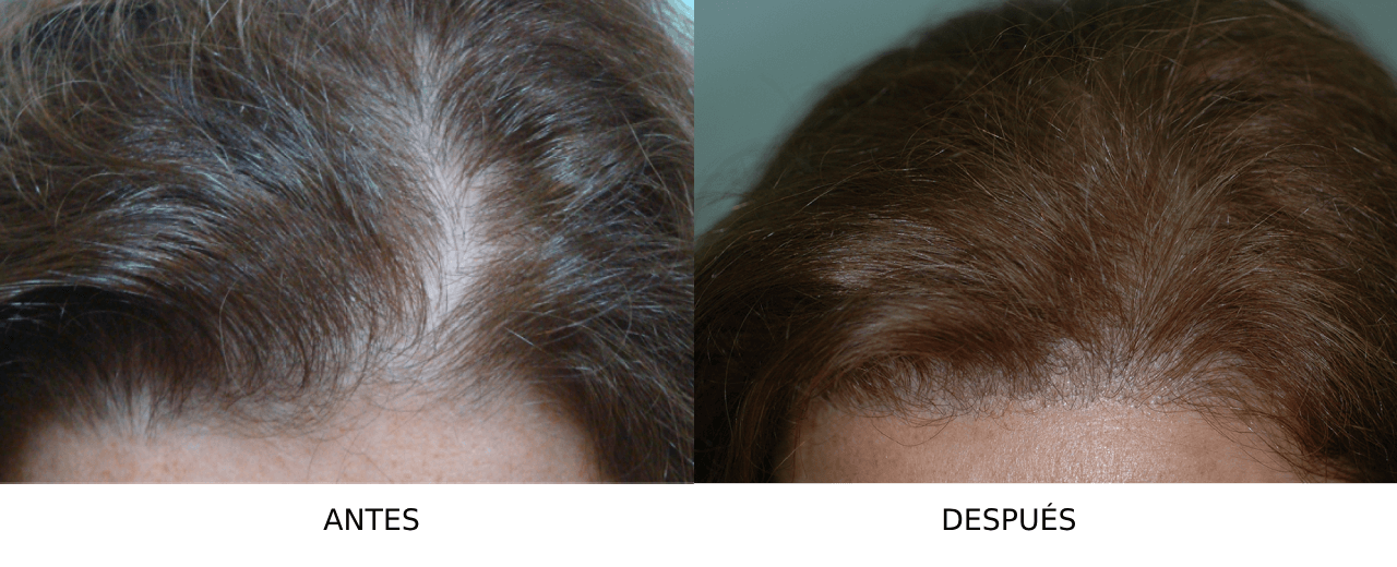 Alopecia